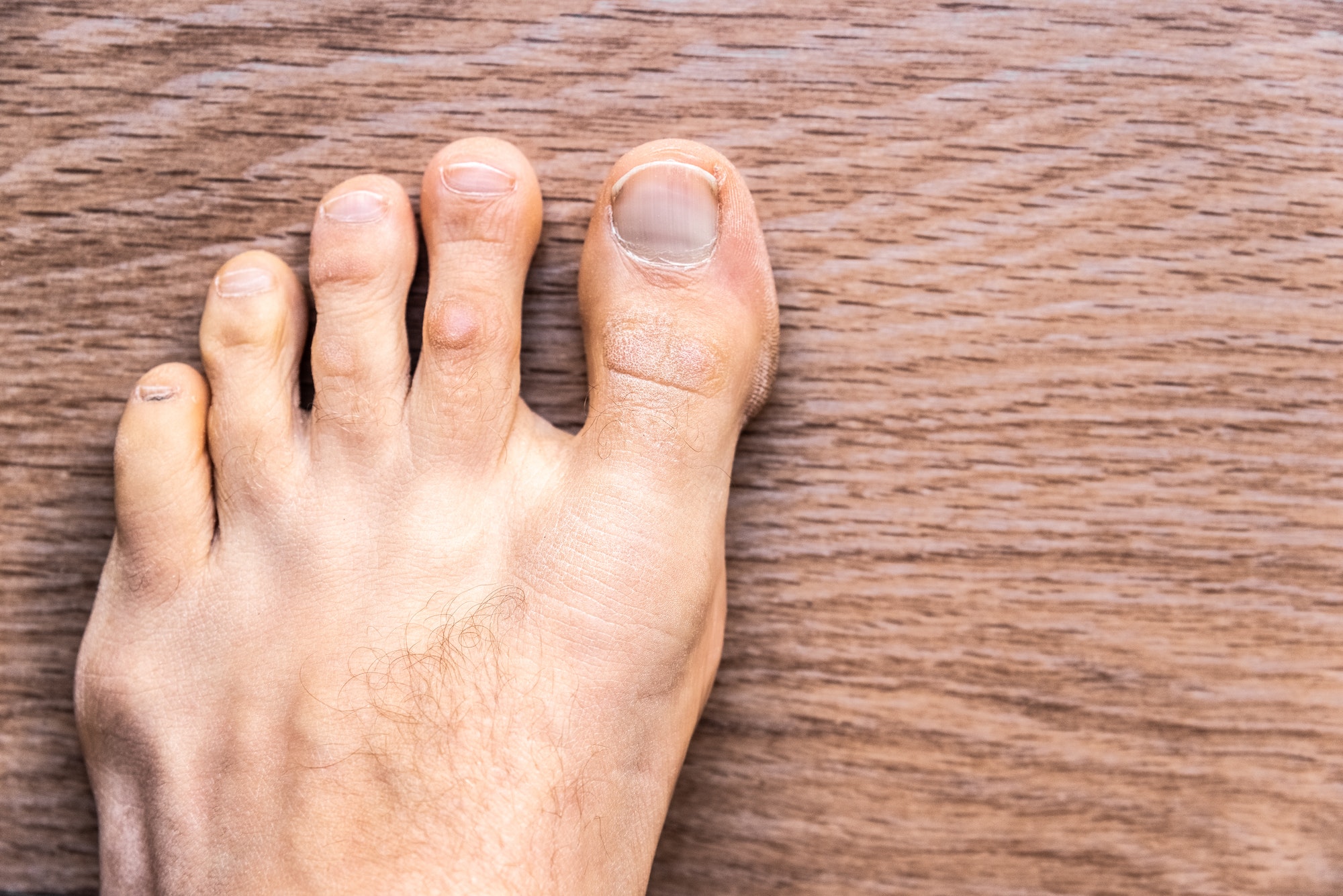 Toes affected by dermal problems, red rash produced plaques of psoriasis.